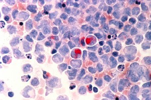 acute myelocytic leukemia (AML) cells