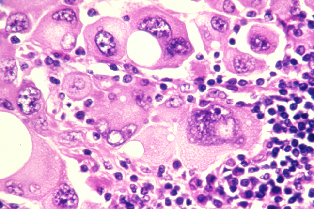 metastatic melanoma cells